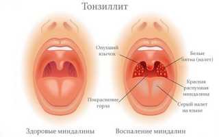 «Тонзилотрен»: инструкция по применению, аналоги, отзывы