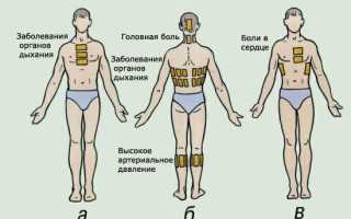 Постановка горчичников, банок. Приготовление и применение грелки и пузыря со льдом.