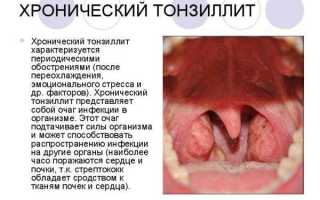Рыхлые гланды как лечить. Причины и лечение рыхлых миндалин у ребенка и взрослого