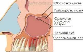 Почему болят зубы при простуде и как их лечить