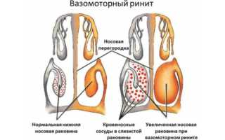 Насморк: чем вылечить быстро и навсегда — лучший способ