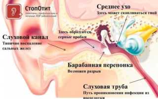 Травматическая перфорация барабанной перепонки и ее лечение