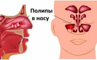Трава от гайморита лечебные свойства и противопоказания фото