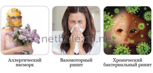 Аллергический насморк, вазомоторный и бактериальный ринит
