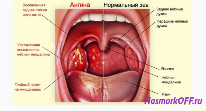 Ангина