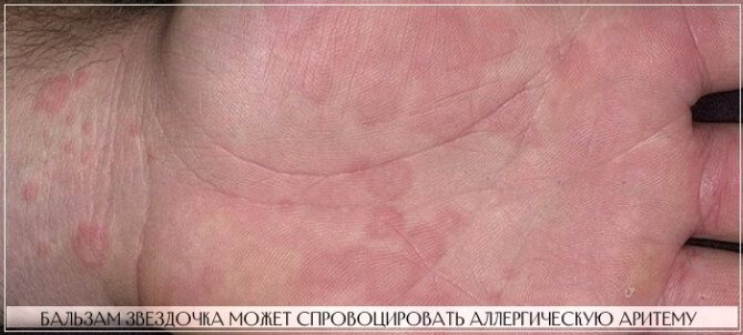 Аритема - побочная реакция организма на бальзам Красная Звезда