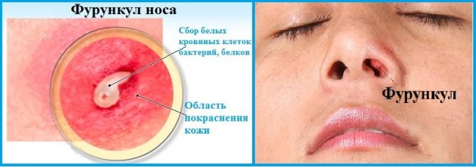 Фурункул в носу