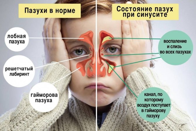 гайморит без насморка как лечить