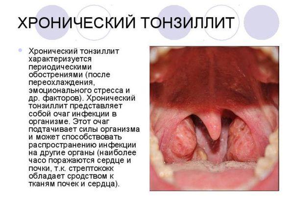 Хронический тонзиллит