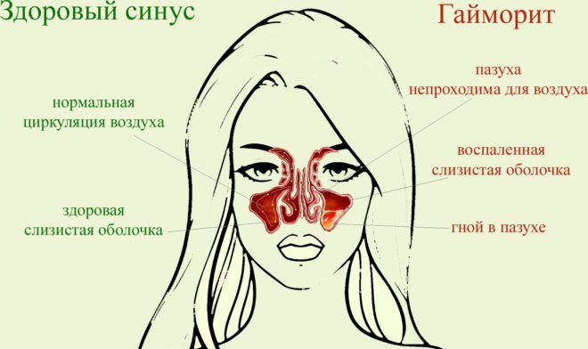 Как применять фурацилиновые капли в нос