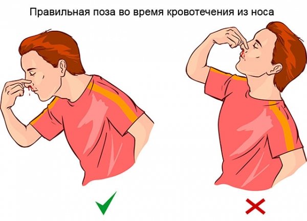 Как сделать так чтоб шла кровь из носа