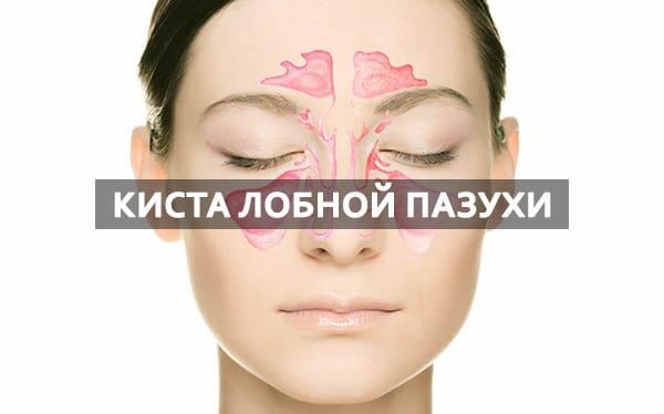 киста у женщины