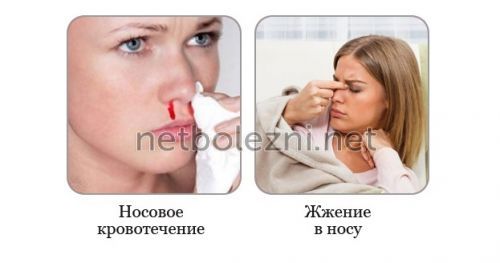 Носовое кровотечение, жжение в носу
