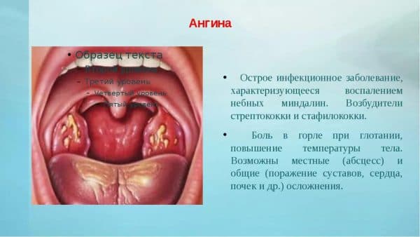 Определение ангины