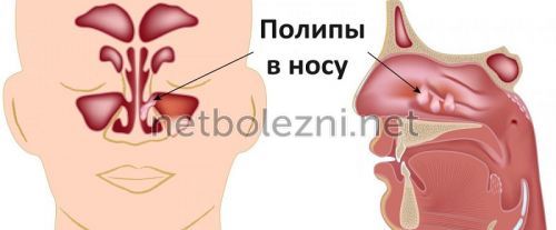 Полипоз носа и околоносовых пазух