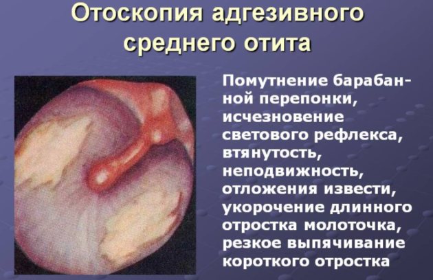 При адгезивном отите допускается проведение процедуры пневмомассажа