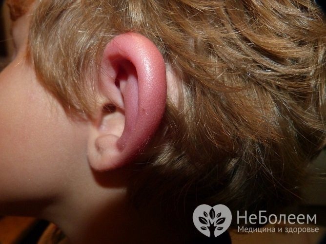 Причиной отека наружного уха чаще всего является травма или аллергия