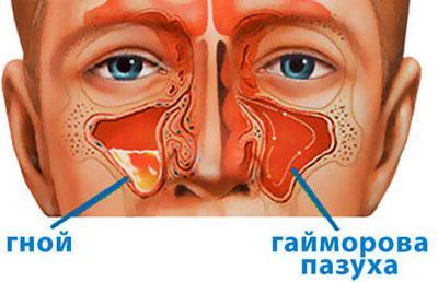 Проявление гайморита