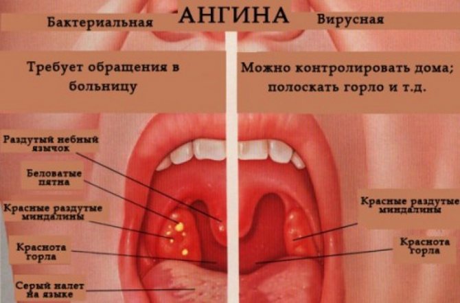 Разновидности ангины
