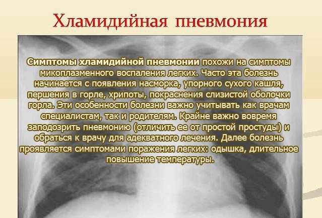 Симптомы хламидийной пневмонии