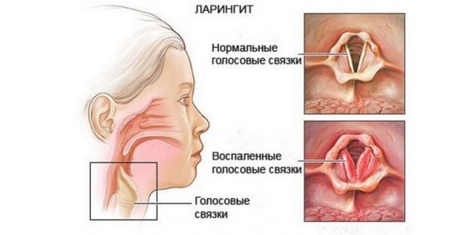 симптомы ларингита