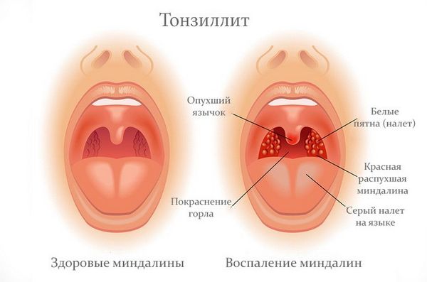 тонзиллит